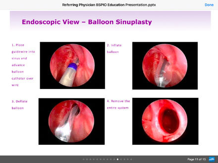 balloon sinuplasty info pic