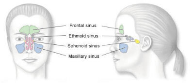 chronic sinusitis medical image