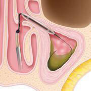 chronic sinusitis