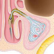 chronic sinusitis