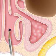 chronic sinusitis